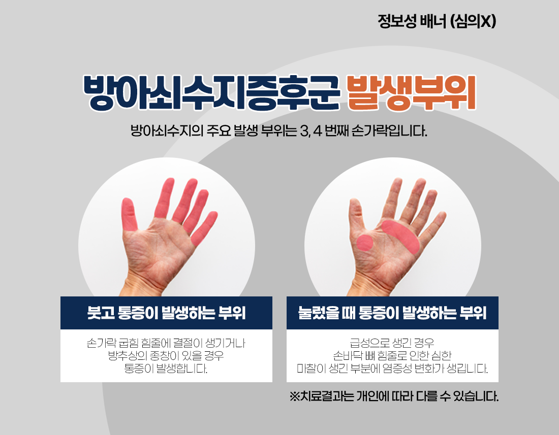 방아쇠수지증후군