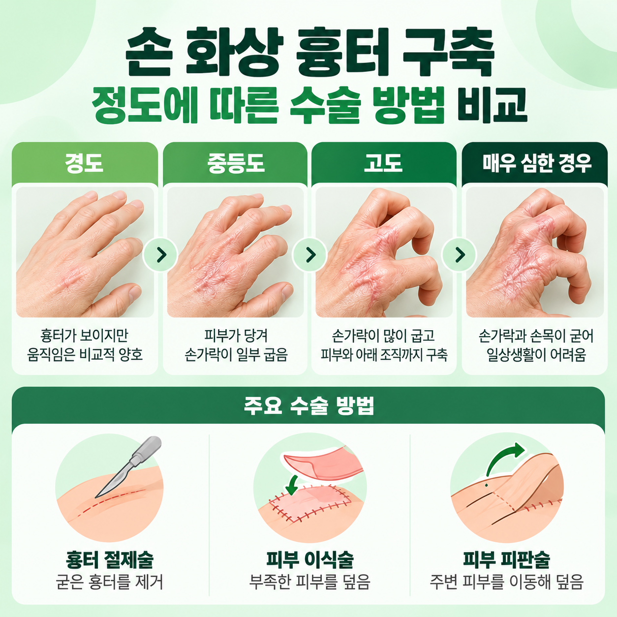 손 화상
